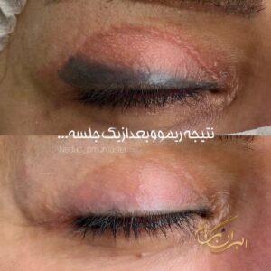 بهترین خدمات تتو ریمووال در تهران | مرکز ریموو تاتو در تهران