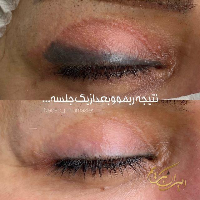 بهترین خدمات تتو ریمووال در تهران | مرکز ریموو تاتو در تهران