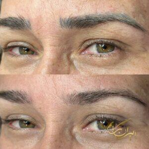 اگر ساکن غرب تهران هستید و به دنبال پاک کردن تضمینی تتو در غرب تهران می‌گردید، ایران فیبروز با ترکیبی از فناوری برتر، تخصص عمیق