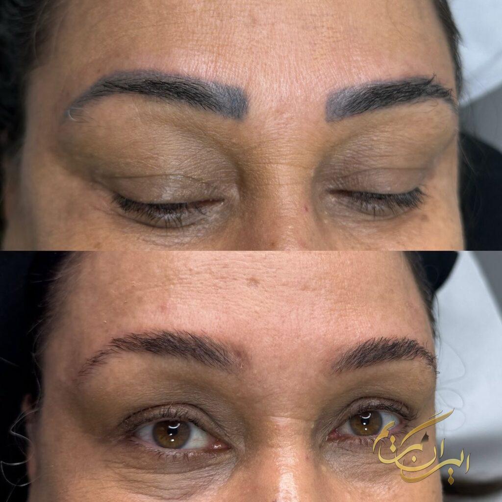 بهترین خدمات تتو ریمووال در شرق تهران | مرکز ریموو تاتو در شرق تهران