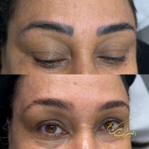 بهترین خدمات تتو ریمووال در شرق تهران | مرکز ریموو تاتو در شرق تهران