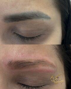 بهترین خدمات تتو ریمووال در جنوب تهران | مرکز ریموو تاتو در جنوب تهران